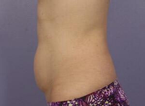 CoolSculpting Before & After Image