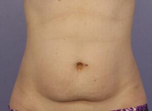 CoolSculpting Before & After Image