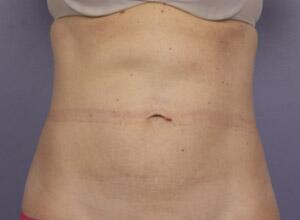 CoolSculpting Before & After Image