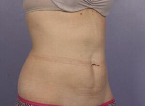 CoolSculpting Before & After Image