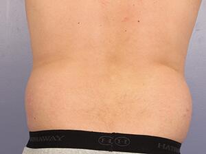 CoolSculpting Before & After Image