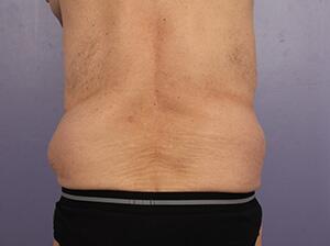 CoolSculpting Before & After Image