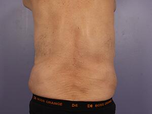 CoolSculpting Before & After Image