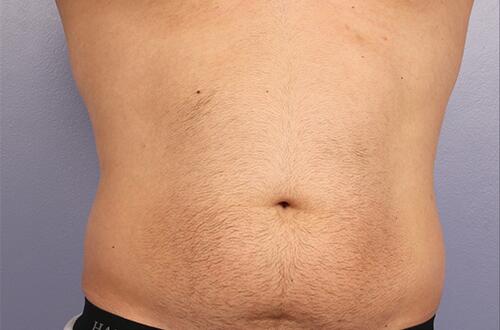 CoolSculpting Before & After Image