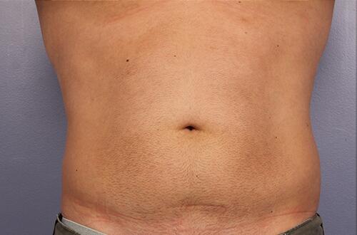 CoolSculpting Before & After Image