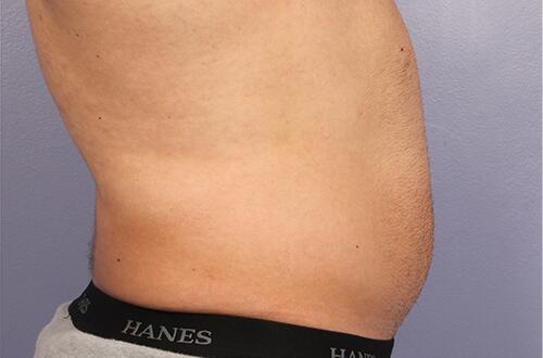 CoolSculpting Before & After Image