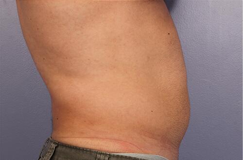 CoolSculpting Before & After Image