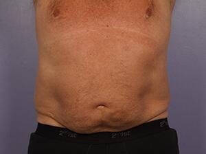 CoolSculpting Before & After Image