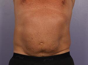 CoolSculpting Before & After Image