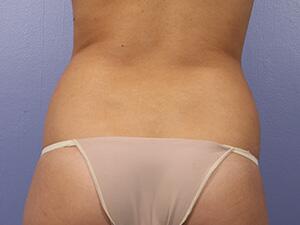 CoolSculpting Before & After Image