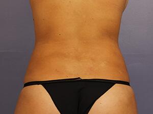 CoolSculpting Before & After Image