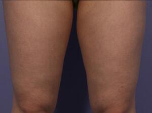 CoolSculpting Before & After Image