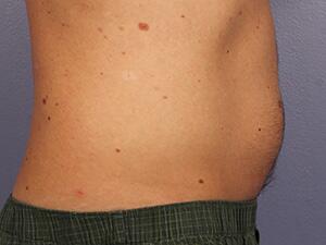 CoolSculpting Before & After Image