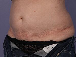 CoolSculpting Before & After Image