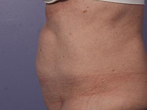 CoolSculpting Before & After Image