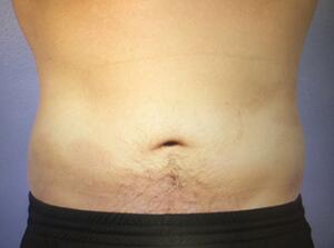 CoolSculpting Before & After Image