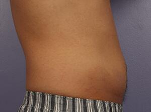 CoolSculpting Before & After Image