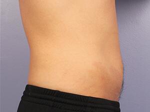 CoolSculpting Before & After Image