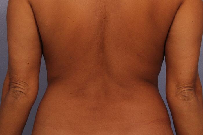 CoolSculpting Before & After Image