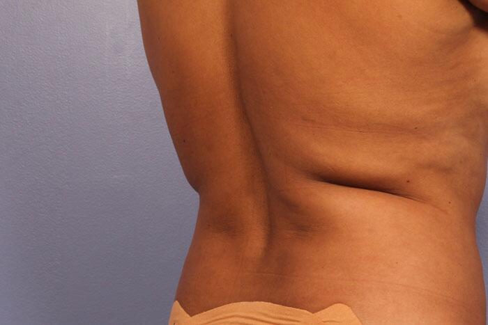 CoolSculpting Before & After Image