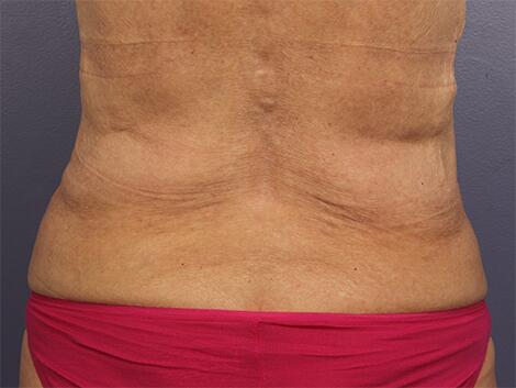 CoolSculpting Before & After Image