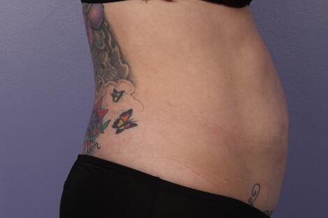 CoolSculpting Before & After Image