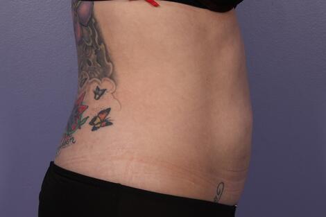 CoolSculpting Before & After Image