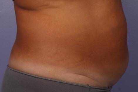 CoolSculpting Before & After Image