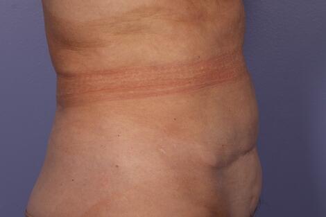 CoolSculpting Before & After Image