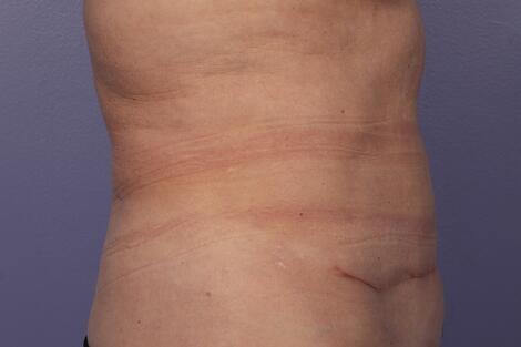 CoolSculpting Before & After Image