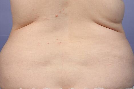 CoolSculpting Before & After Image