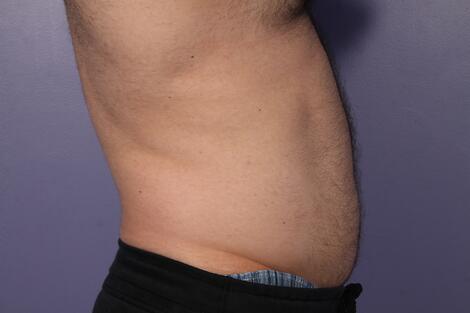 CoolSculpting Before & After Image