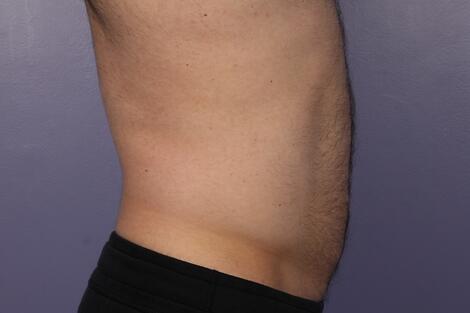 CoolSculpting Before & After Image