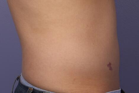 CoolSculpting Before & After Image