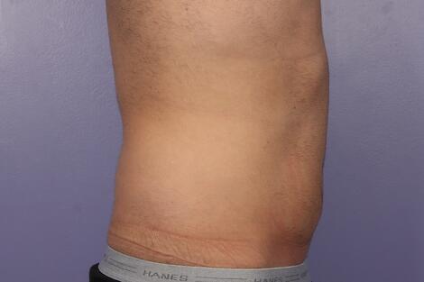 CoolSculpting Before & After Image