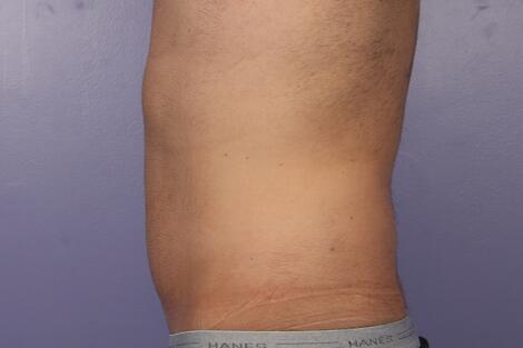 CoolSculpting Before & After Image