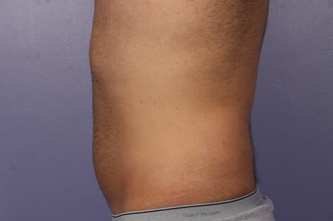 CoolSculpting Before & After Image