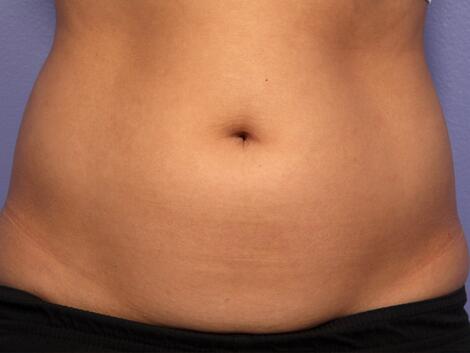 CoolSculpting Before & After Image