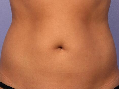 CoolSculpting Before & After Image