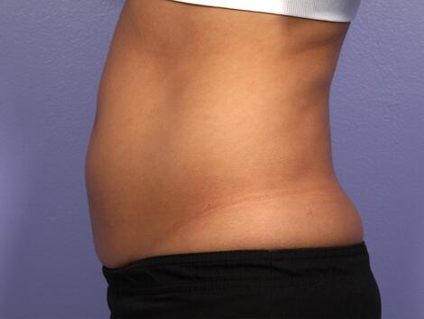 CoolSculpting Before & After Image