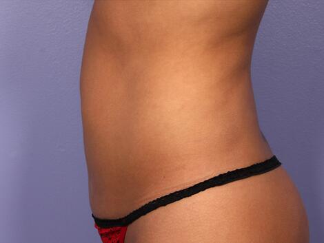 CoolSculpting Before & After Image