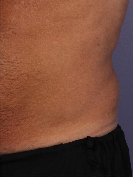 CoolSculpting Before & After Image