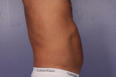 CoolSculpting Before & After Image