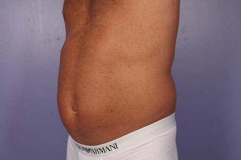 CoolSculpting Before & After Image