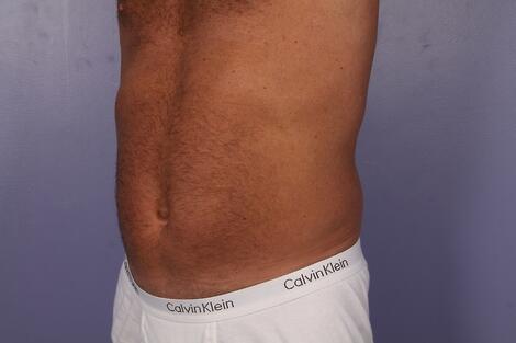 CoolSculpting Before & After Image