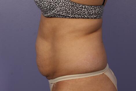 CoolSculpting Before & After Image