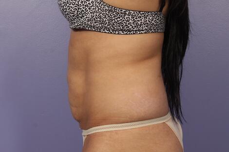 CoolSculpting Before & After Image