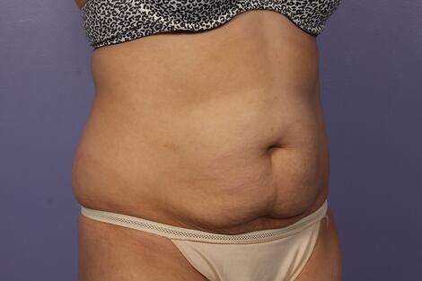 CoolSculpting Before & After Image