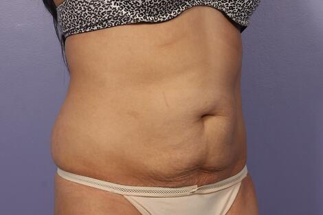 CoolSculpting Before & After Image