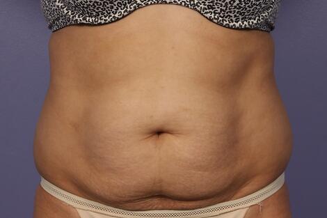 CoolSculpting Before & After Image